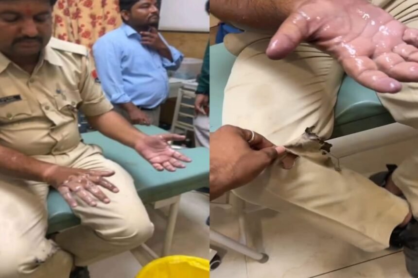 तेज़ाब पीते युवक की जान बचाई, कॉन्स्टेबल के जले हाथ; पति-पत्नी के झगड़े में हुई झड़प, दोनों अस्पताल में भर्ती WhatsApp Image 2025 08 21 at 12.14.24